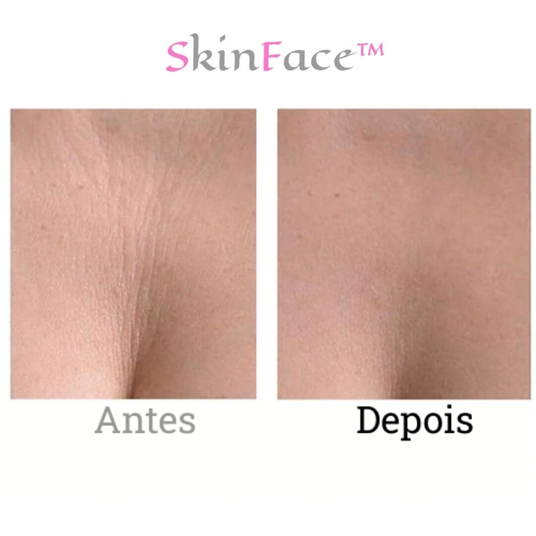 SkinFace™ - Adesivos de Silicone Rejuvenescedor Anti Rugas
